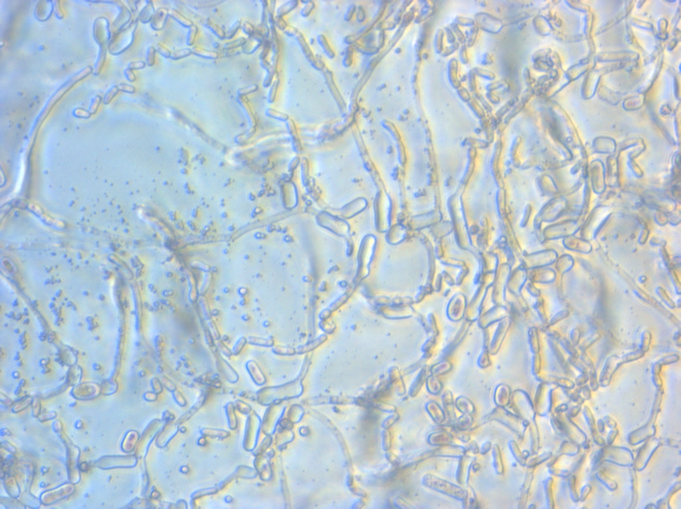 Aspergillus tracheobronchitis, bronchopleural fistula and empyema after lobectomy for aspergilloma